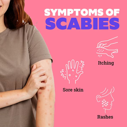 Scabies Treatment for Kids
